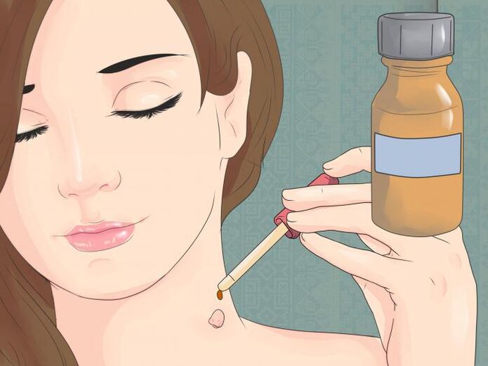 Uporaba zdravila v obliki raztopine za odstranjevanje papiloma na vratu