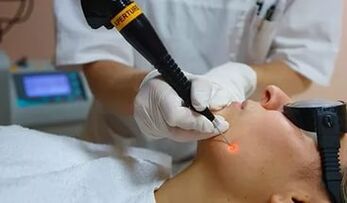 Učinkovit postopek za odstranjevanje papiloma na obrazu z laserjem