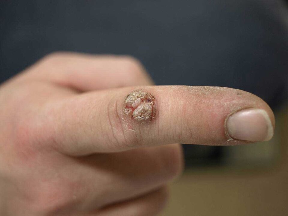 Velika bradavica na prstu, ki jo je treba odstraniti