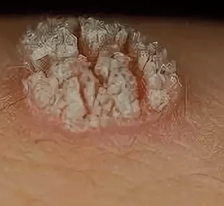 Preprosti papilomi
