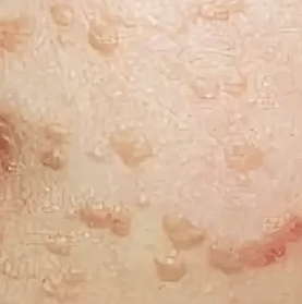 Ravni papilomi