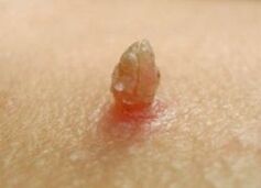 Oster papiloma