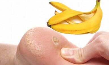 Banana lupina za zdravljenje plantarne bradavice