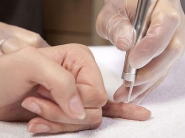 Izvajanje laserske terapije