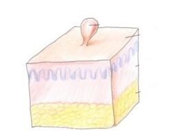 kako se znebiti papiloma na telesu