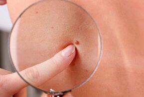 vzroki za pojav papiloma na človeškem telesu