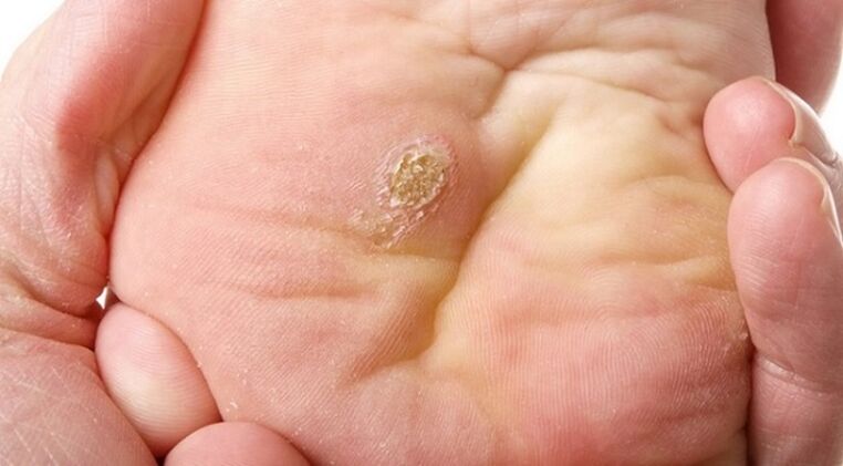 plantarni in ravni papilomi