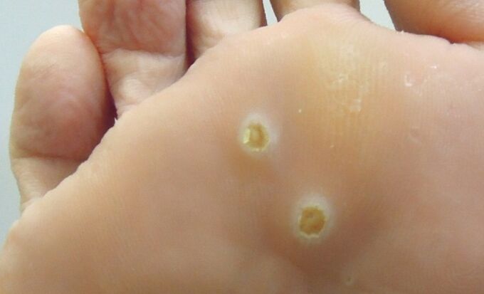 plantarni papilomi na nogi